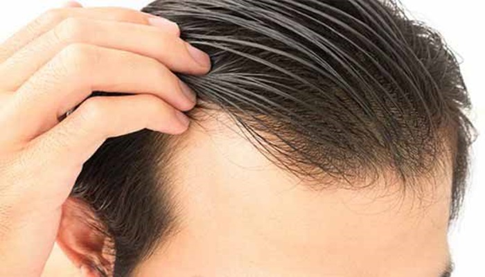 بهترین دکتر کاشت مو: دکتر مسلم صفر پور