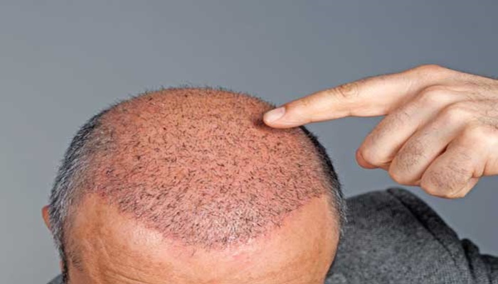 بهترین دکتر کاشت مو: دکتر پریسا پیروی