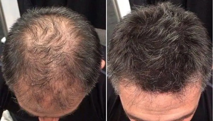 شناخت بهترین کلینیک کاشت مو در شیراز