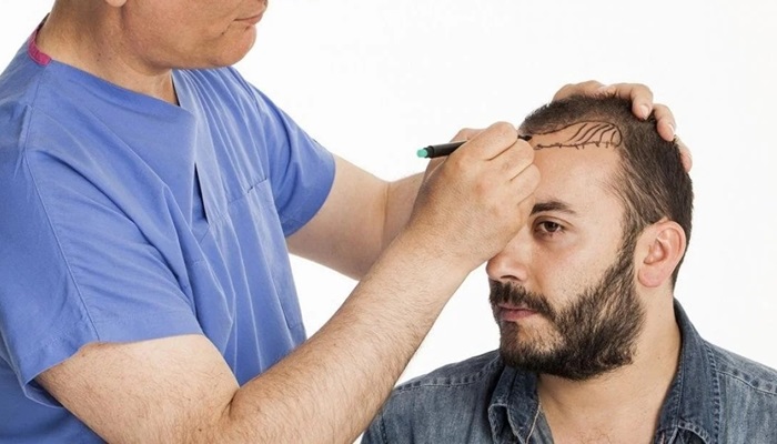 شناخت بهترین کلینیک کاشت مو در مشهد