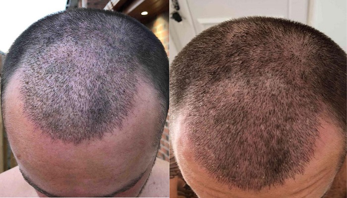 لیست بهترین کلینیک کاشت مو در تبریز