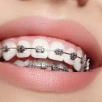 بهترین دکتر ارتودنسی در اصفهان